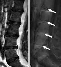 MRI of the lumbar spine of a subject with chronic low back pain and disability. (Left) T2-weighted MRI noting multilevel disc degeneration and Modic changes. (Right) Ultra-short time-to-echo (UTE) MRI noting multilevel UTE disc sign (UDS), noted by white arrows.